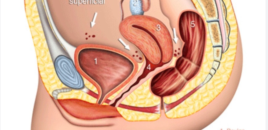 endometriose peritoneal
