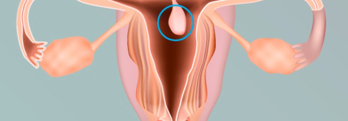 POLIPOS ENDOMETRIAIS
