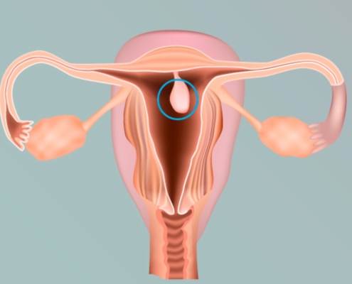 POLIPOS ENDOMETRIAIS