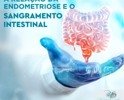 SANGRAMENTO INTESTINAL E ENDOMETRIOSE